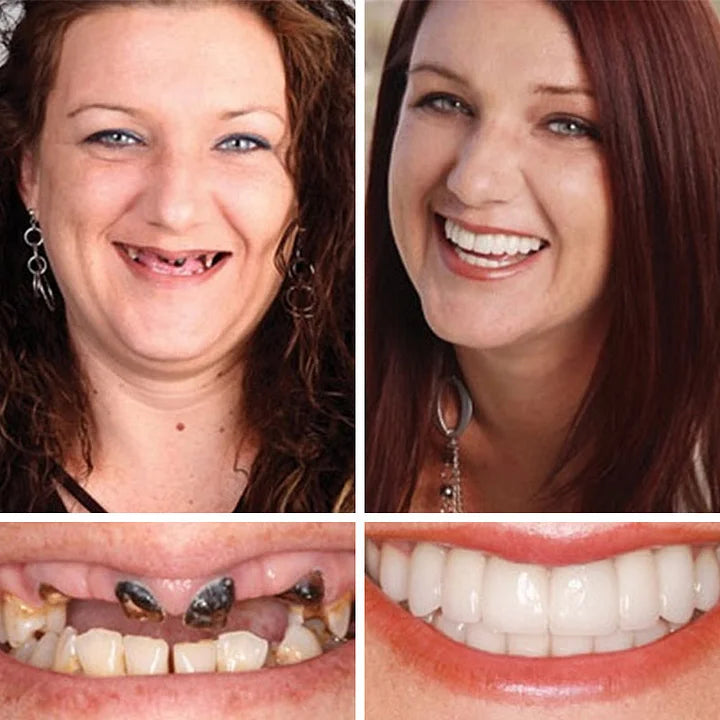 SmileLock – Premium Full Denture Solution